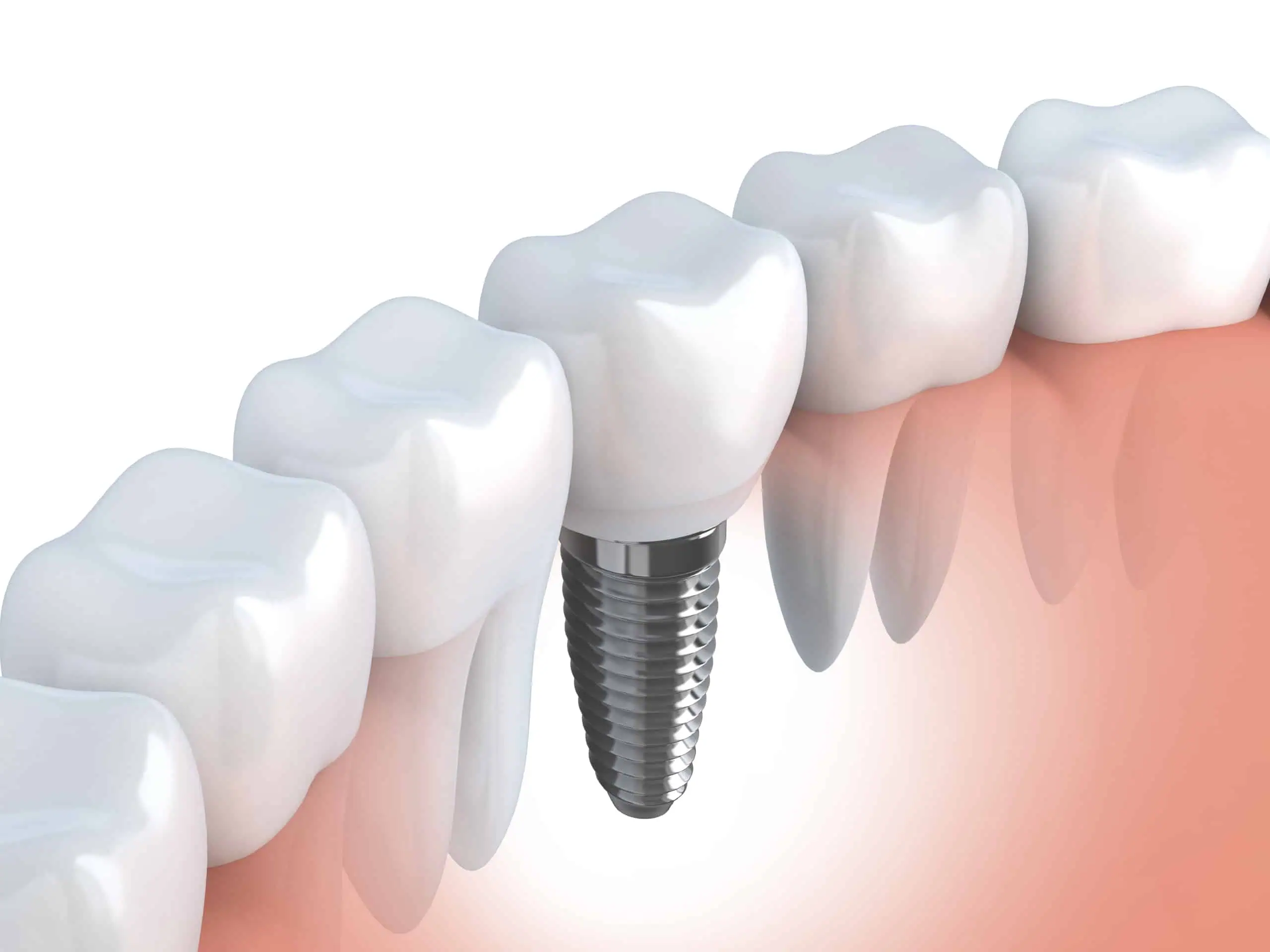 Dental Touch Associates uses dental implants to replace missing teeth - Cedar Rapids, IA - Dental Touch Associates