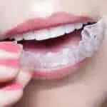 invisalign adults-Dental Touch-Cedar Rapids IA