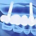 3-d dental imaging-Dental Touch-Cedar Rapids IA